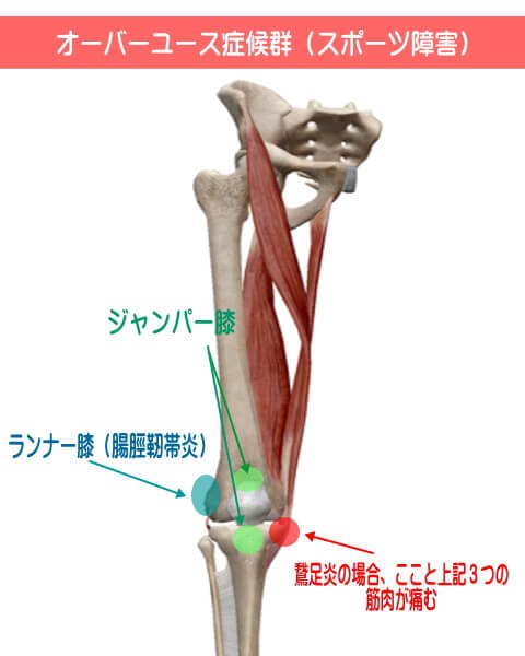 膝の痛み