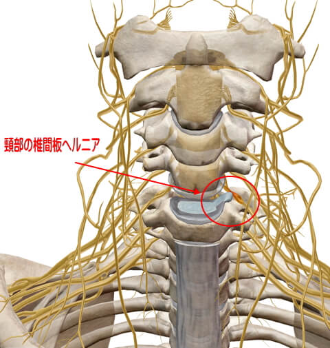 頸部の椎間板ヘルニア