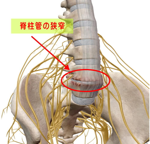 狭窄