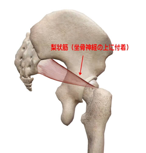 梨状筋症候群